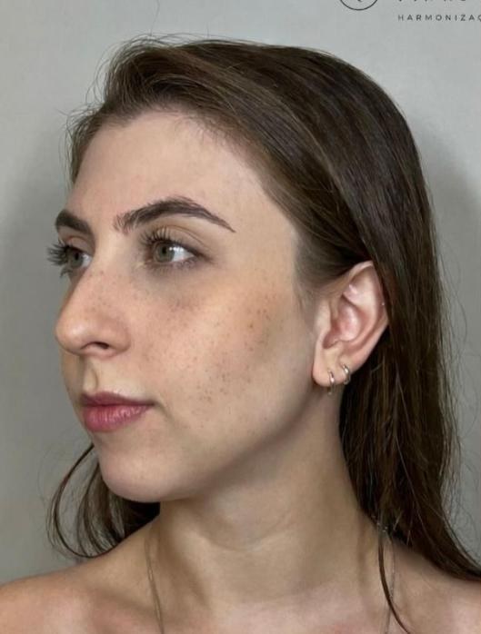 Perfil facial antes do tratamento
