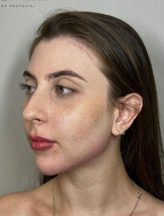 Perfil facial após o tratamento